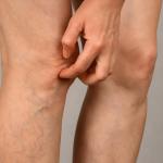 Itchy Varicose Veins