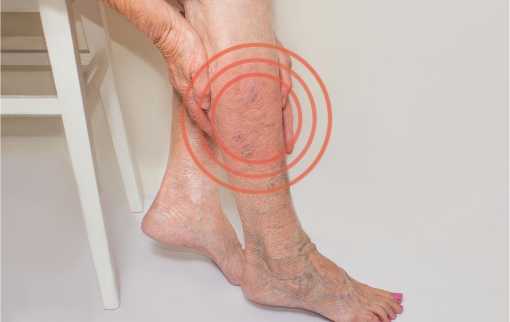 Tips for Varicose and Spider Veins Treatment Blog