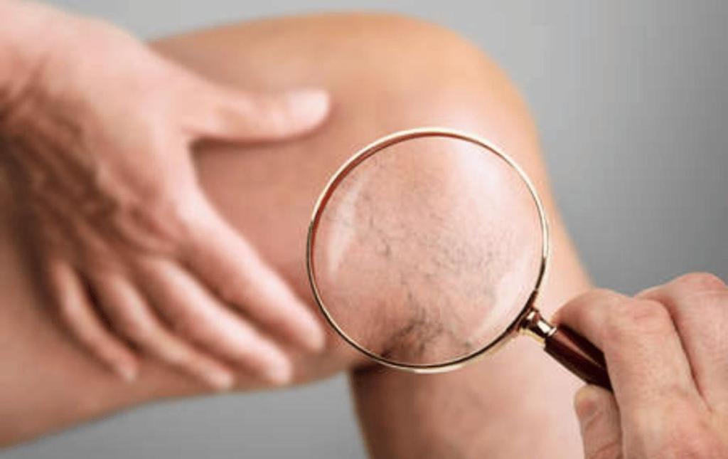 What’s The Difference Between Superficial Veins and Deep Veins