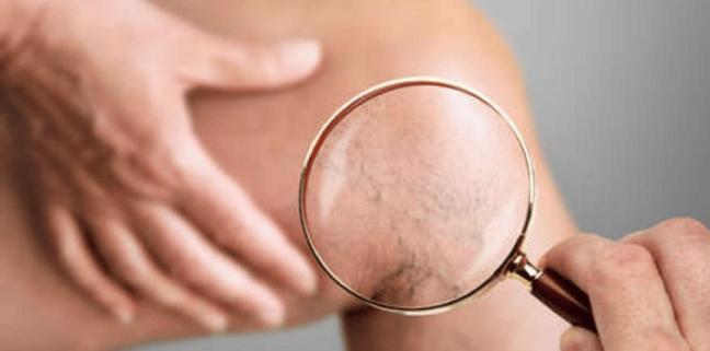 What’s The Difference Between Superficial Veins and Deep Veins