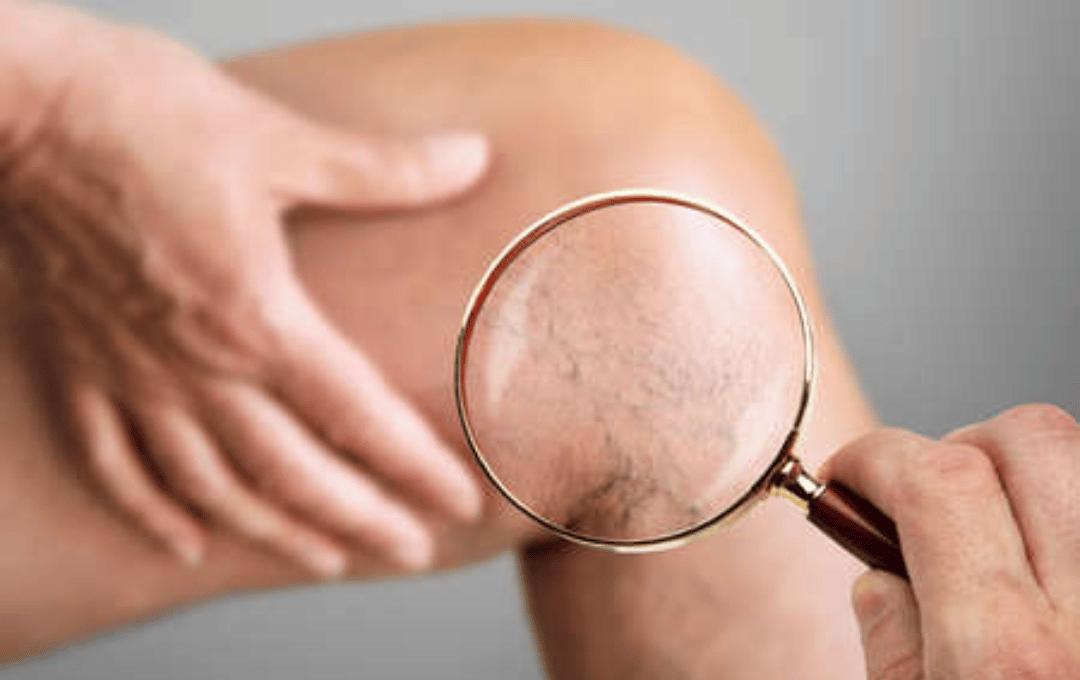 What’s The Difference Between Superficial Veins and Deep Veins