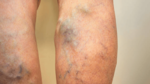 Factors That Make Green Veins More Visible