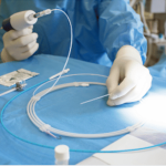 Guide to the Vein Ablation Procedure for Varicose Veins