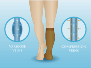 Recovery After Vein Ablation