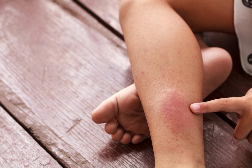blood clot in the leg