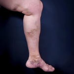 Veins in My Feet Bulging