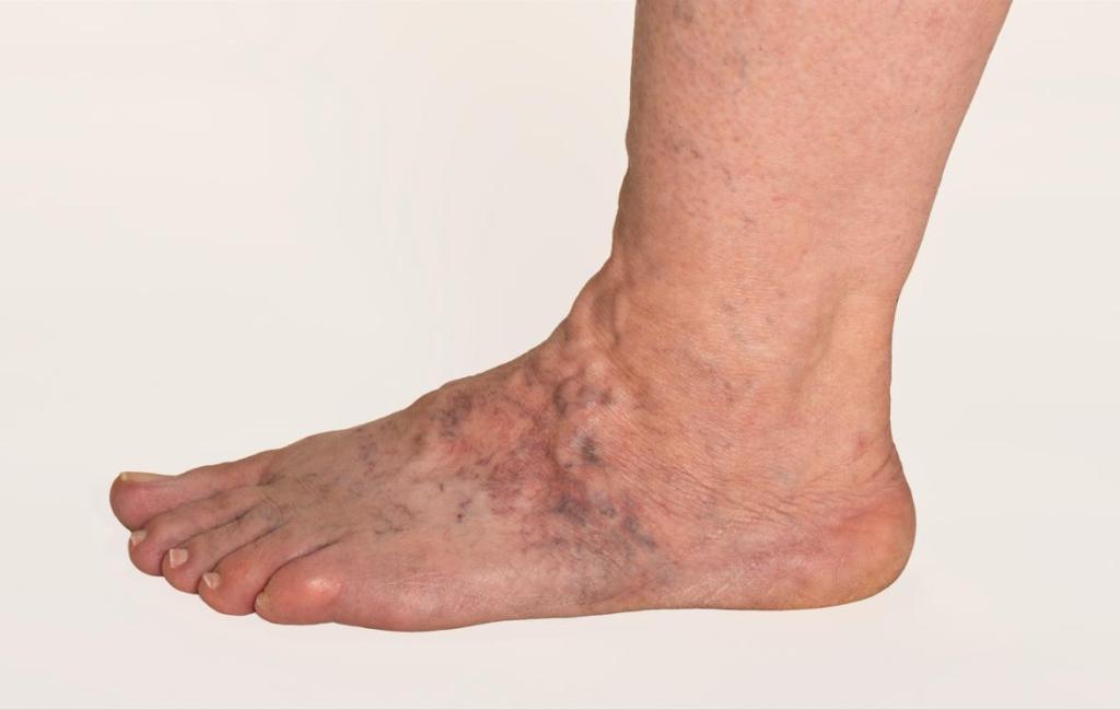 Veins in Feet Bulging