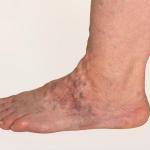 Veins in Feet Bulging