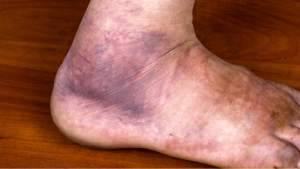 What Do Blood Clots in the Legs Look Like?​