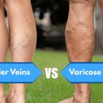 Spider Veins and Varicose Veins 1
