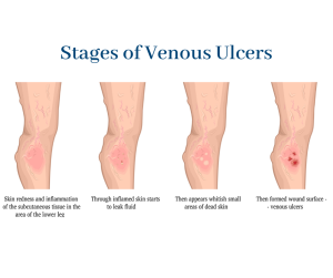 Stages of venous ulcers