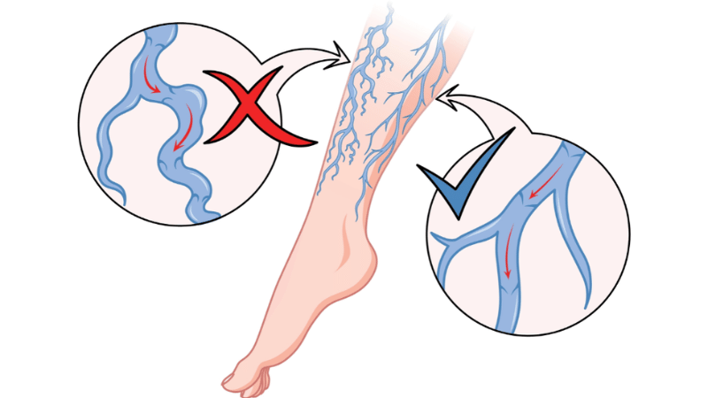 What Are Vein Valves? 5 Diagram showing one-way vein valve function in the leg
