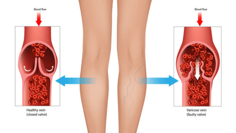 What Are Vein Valves? 6 Illustration of vein valve role in circulatory health and blood flow