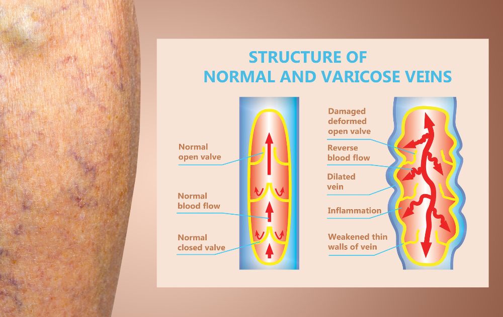 What to Know About Vein Valves