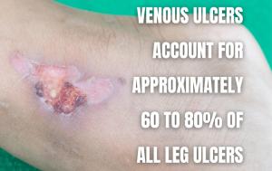 Venous ulcers account for approximately 60 to 80 percent of all leg ulcers 