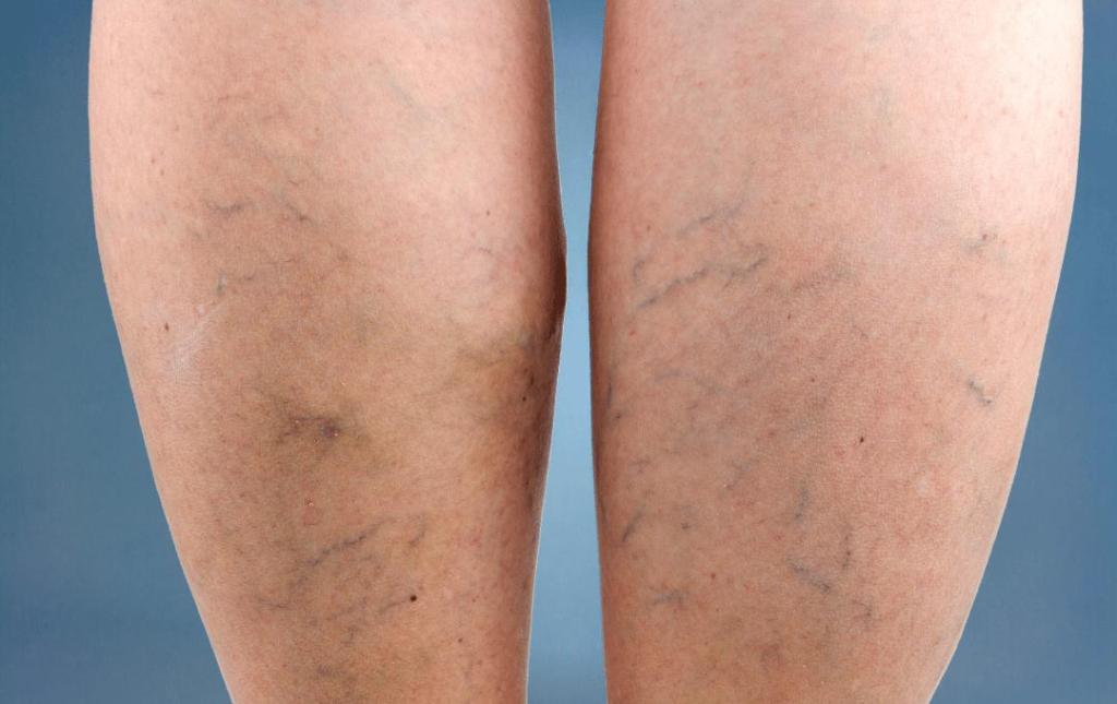 What Your Purple, Blue, or Green Veins Mean
