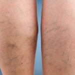 What Your Purple, Blue, or Green Veins Mean