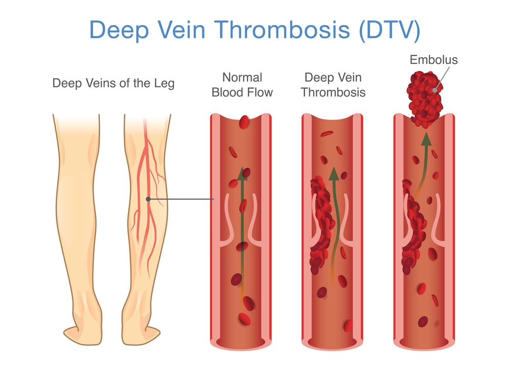 What is Deep Vein Thrombosis