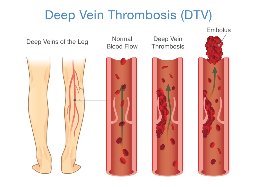 Deep Vein Thrombosis (DVT): Symptoms, Causes, & Treatment