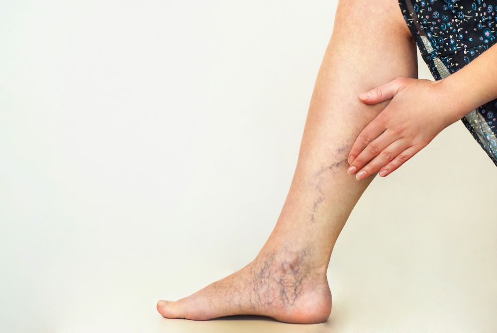Self Exam for Varicose Vein Treatment
