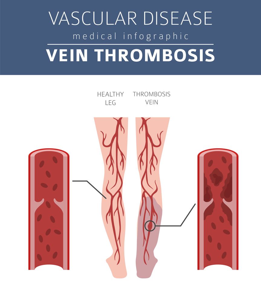 Deep Vein Thrombosis: Causes, Symptoms, Risk Factors, Diagnosis, Treatment,  Prevention and Complications