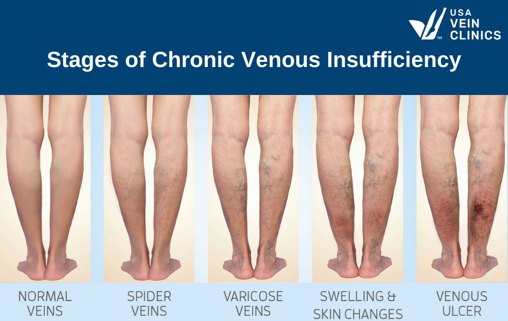 The stages of chronic venous insufficiency - VAI