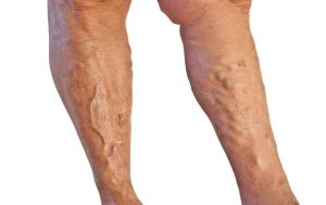 varicose veins