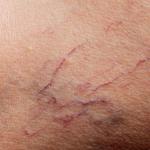 Do Tiny Veins Affect Blood Pressure? 7 tiny veins