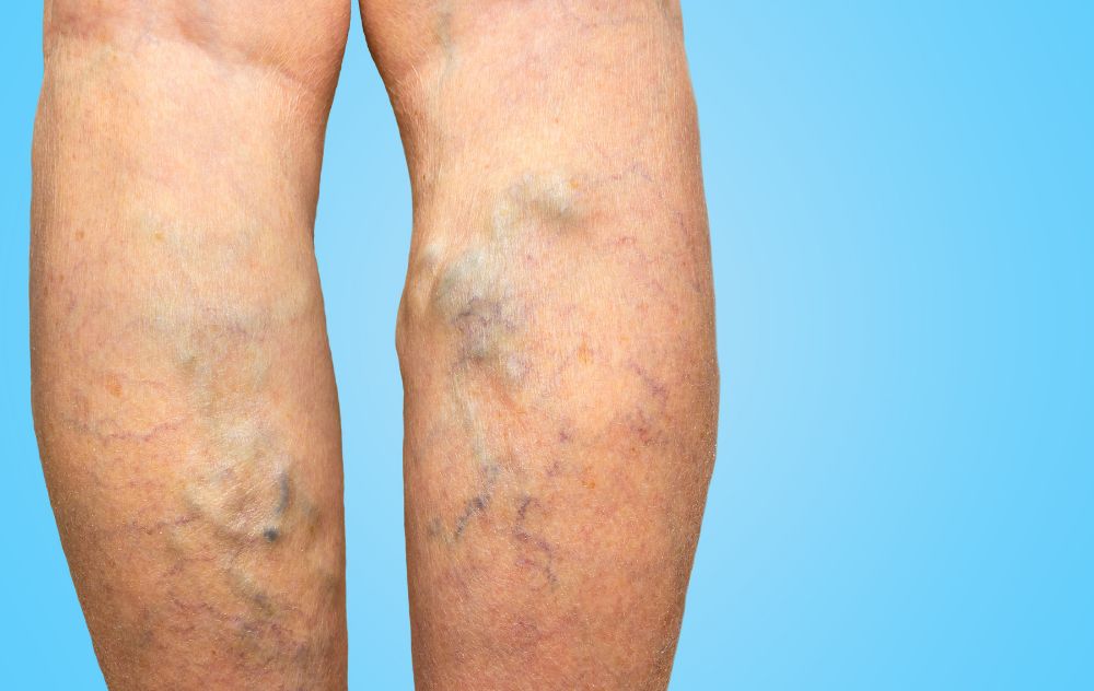 varicose veins in the legs bulging due to high blood pressure