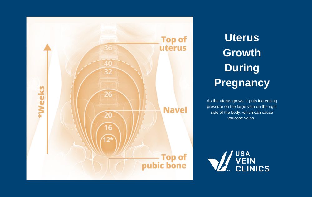 Varicose Veins During Pregnancy Blog Refresh Image 1