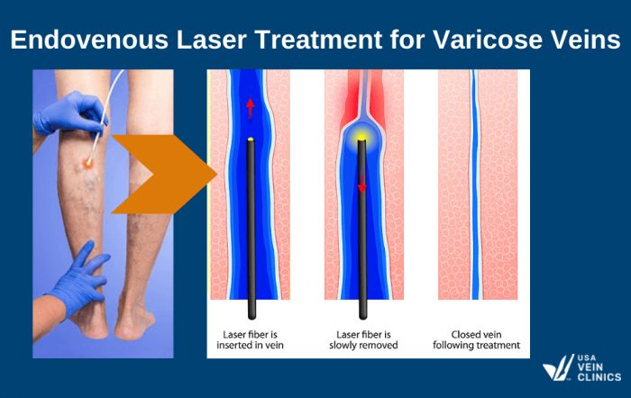 endovenous laser treatment