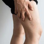 Sclerotherapy Treatment for Spider Veins