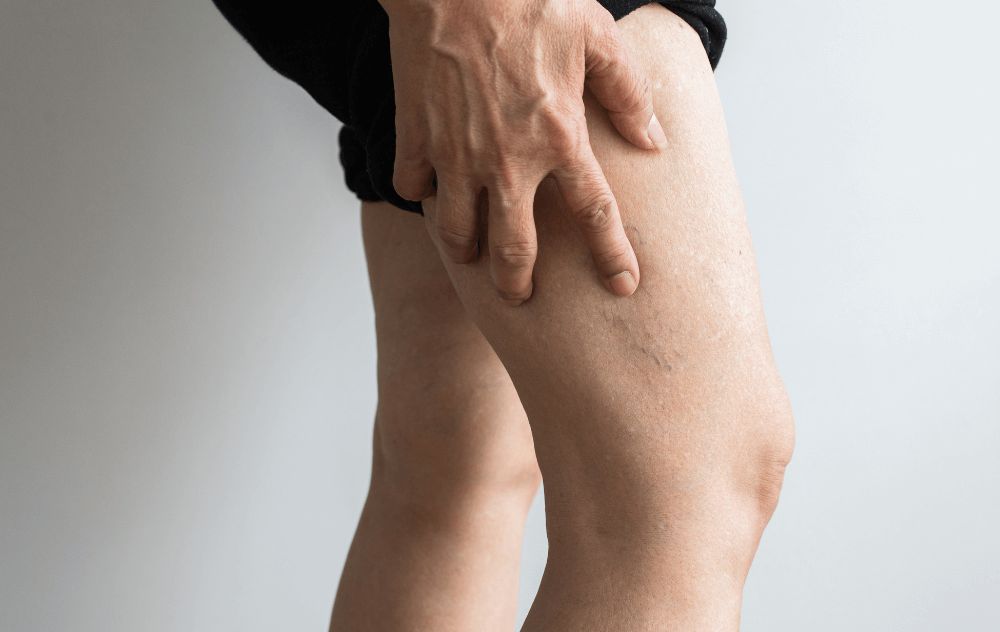 Tips for relieving heavy legs - CEO Médic