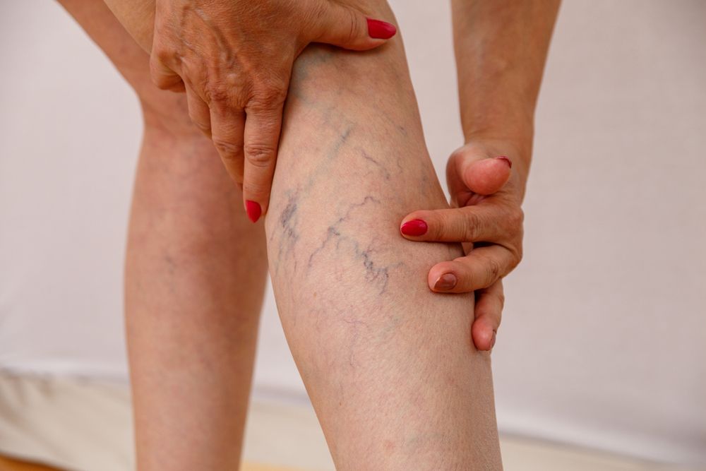 menopause and varicose veins