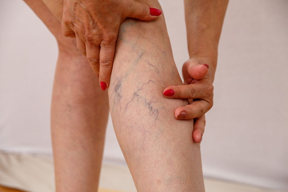 menopause and varicose veins