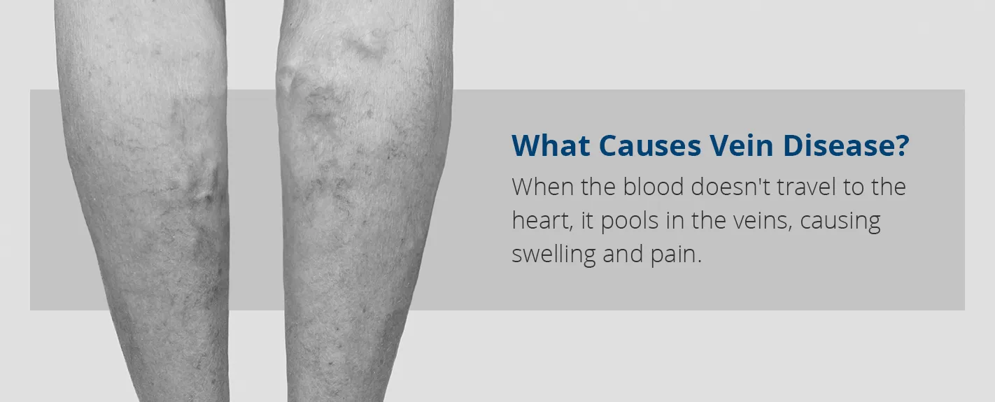 History of Vein Therapy: Where is Was & How It's Improved