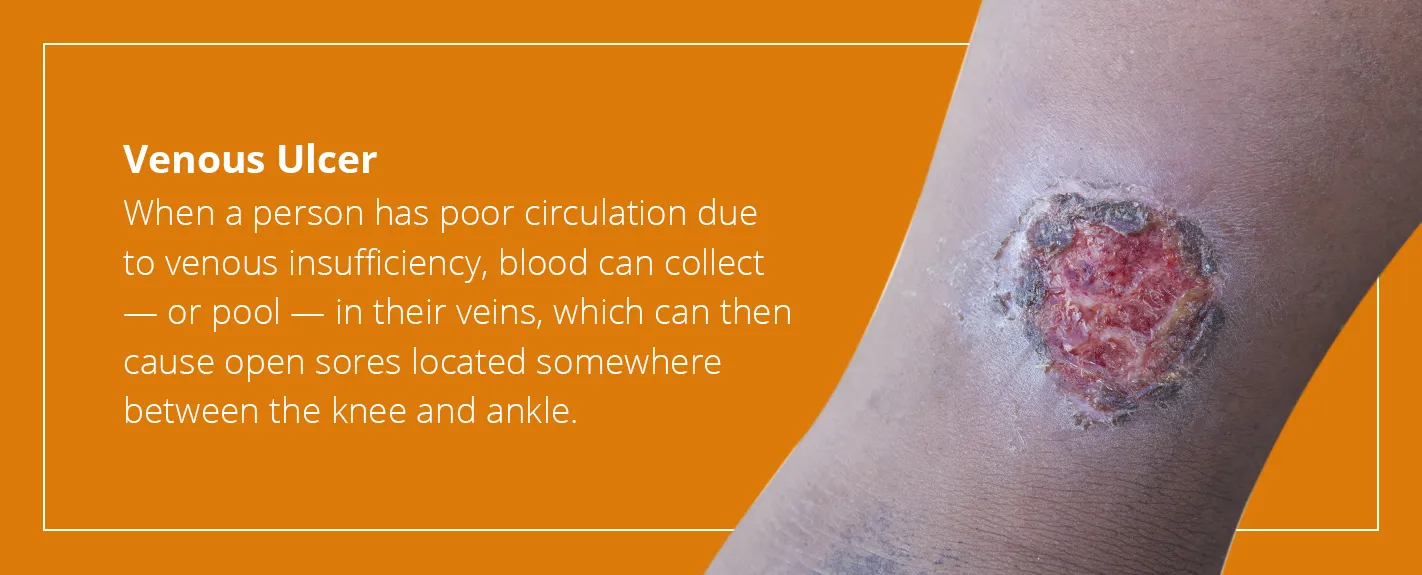 History of Vein Therapy: Where is Was & How It's Improved