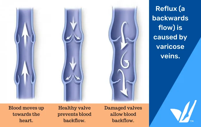 damaged vein valves