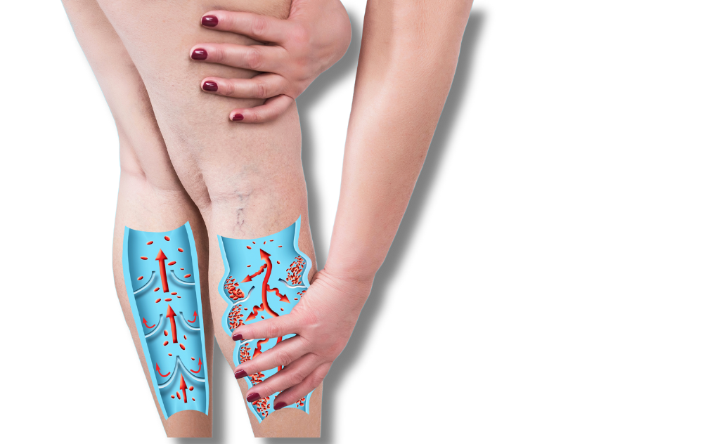 Can Varicose Veins Go Away After Pregnancy?