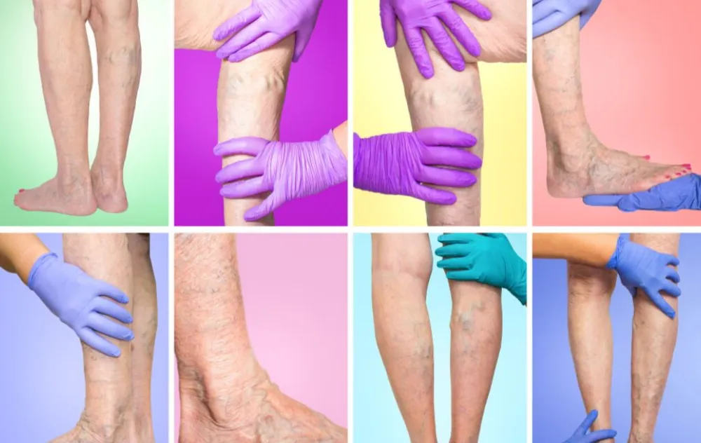 can varicose veins be dangerous if left untreated doctor examining vein diseased legs