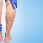 can varicose veins burst