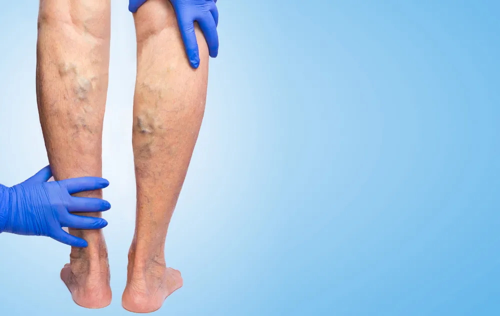 can varicose veins burst