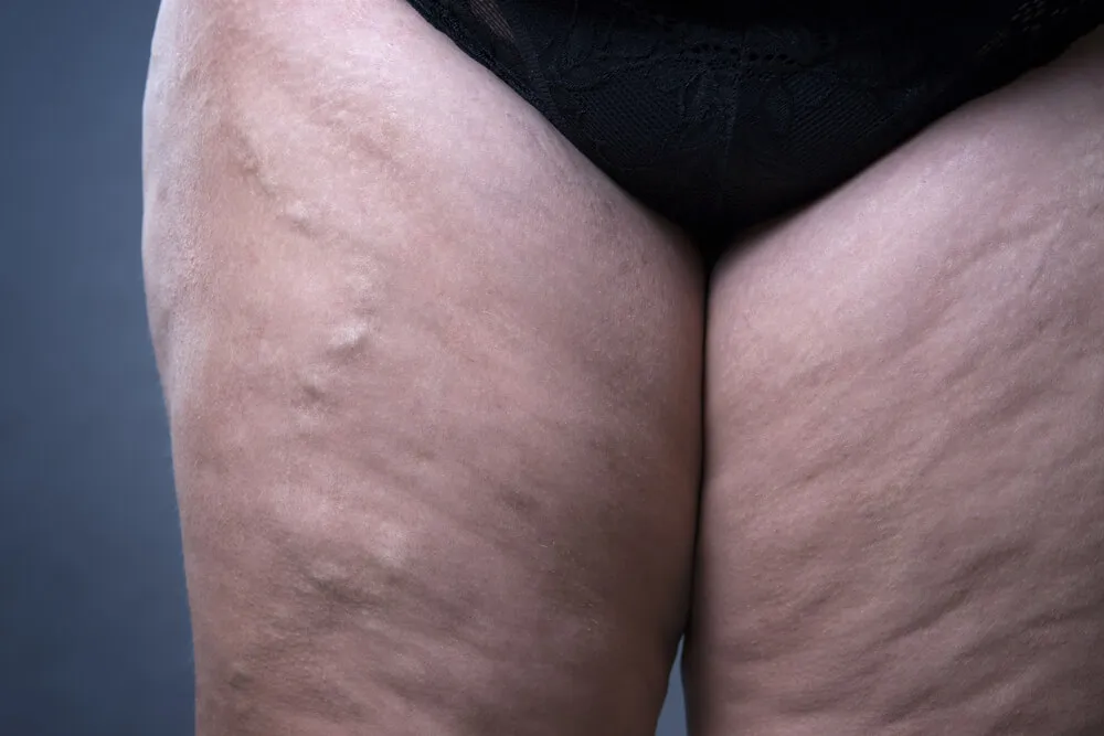 Varicose Veins on the Legs