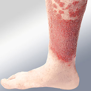 venous stasis dermatitis