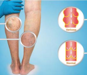 Varicose Veins Explained