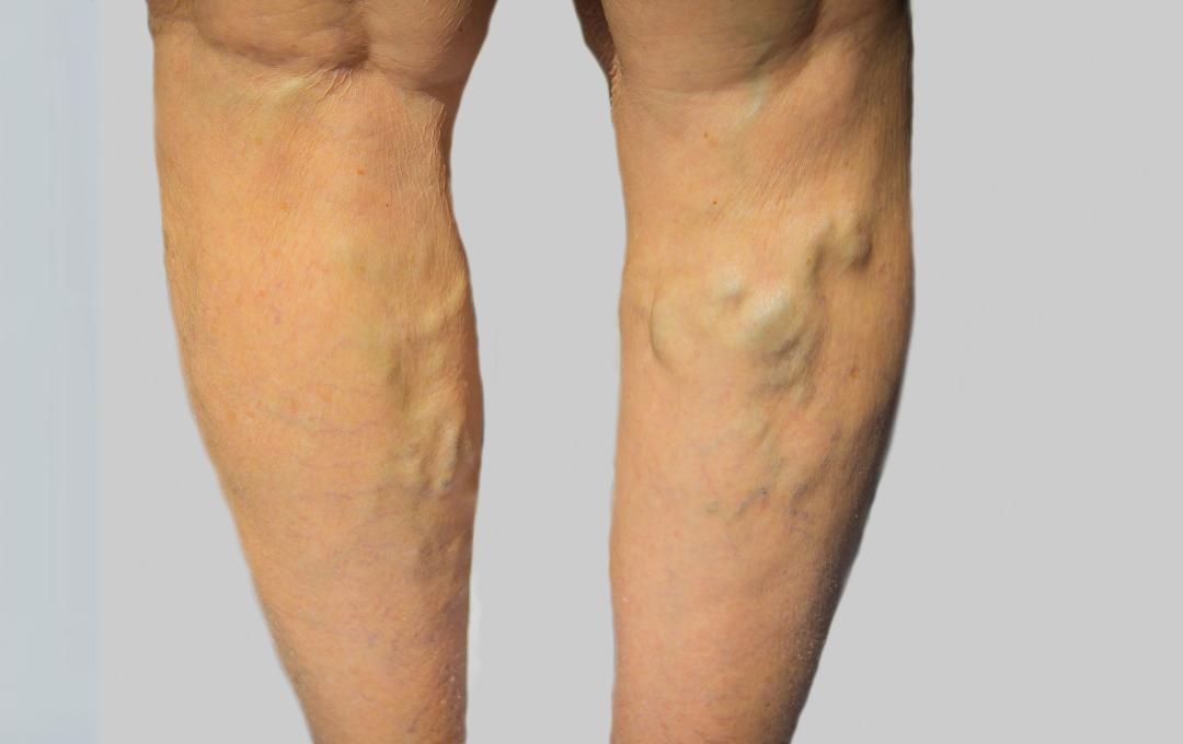 Varicose veins on the legs
