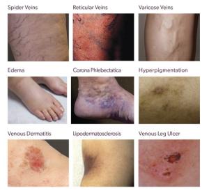 Examples of Vein Disease