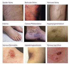 6 Things to Know About Varicose Veins