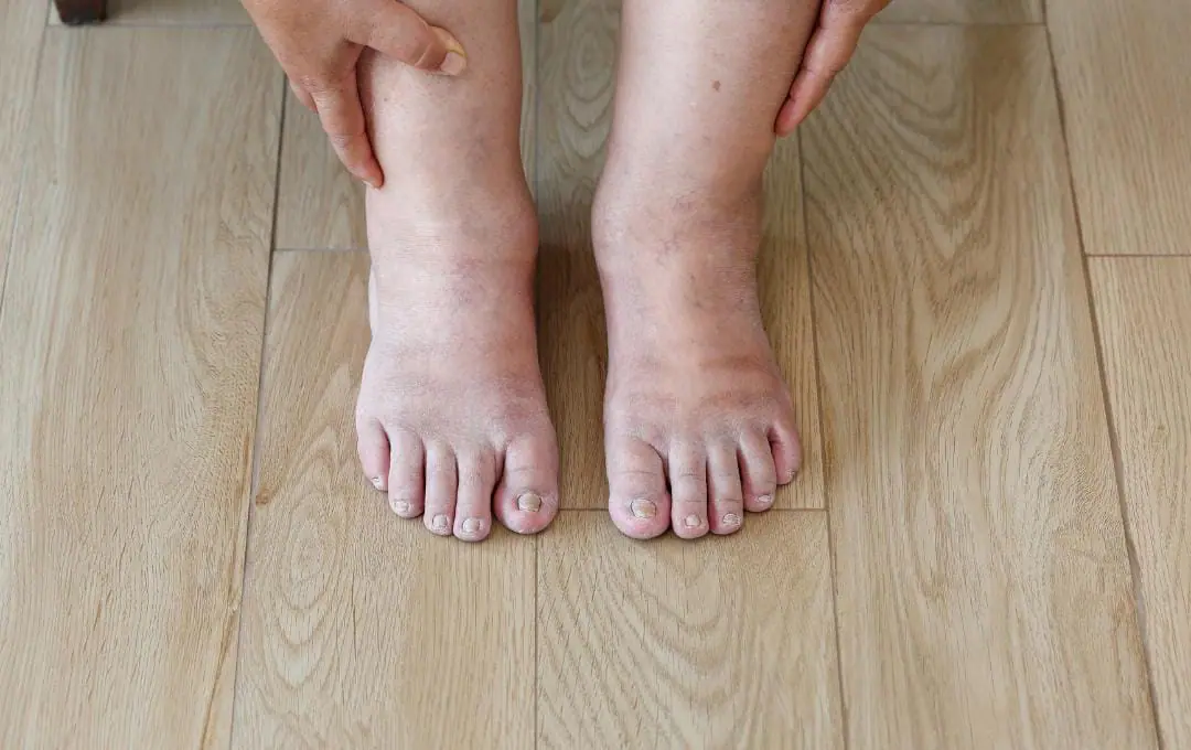 what-causes-blood-to-pool