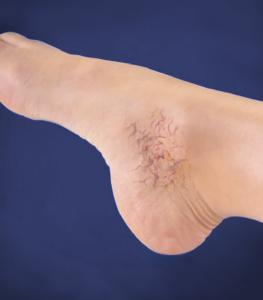 spider veins illustration